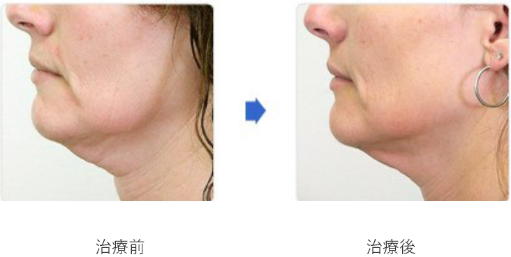 サーマクール フラクショナル 冷却 高周波 サーマクールFLX/CPT｜医療